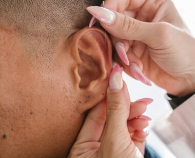 Detailed close-up of an acupuncture treatment performed on the ear for wellness.